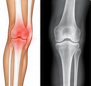 Knee joint and its X-ray showing bone changes